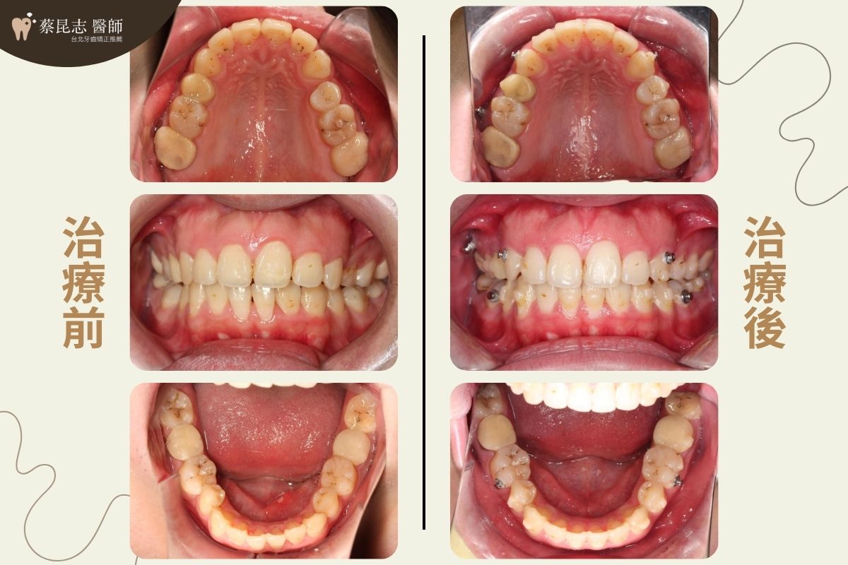 用隱適美做二次矯正，口腔正面圖