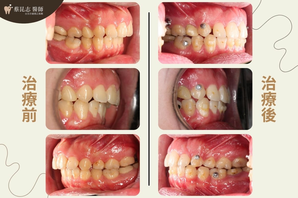 用隱適美做二次矯正，口腔側面圖