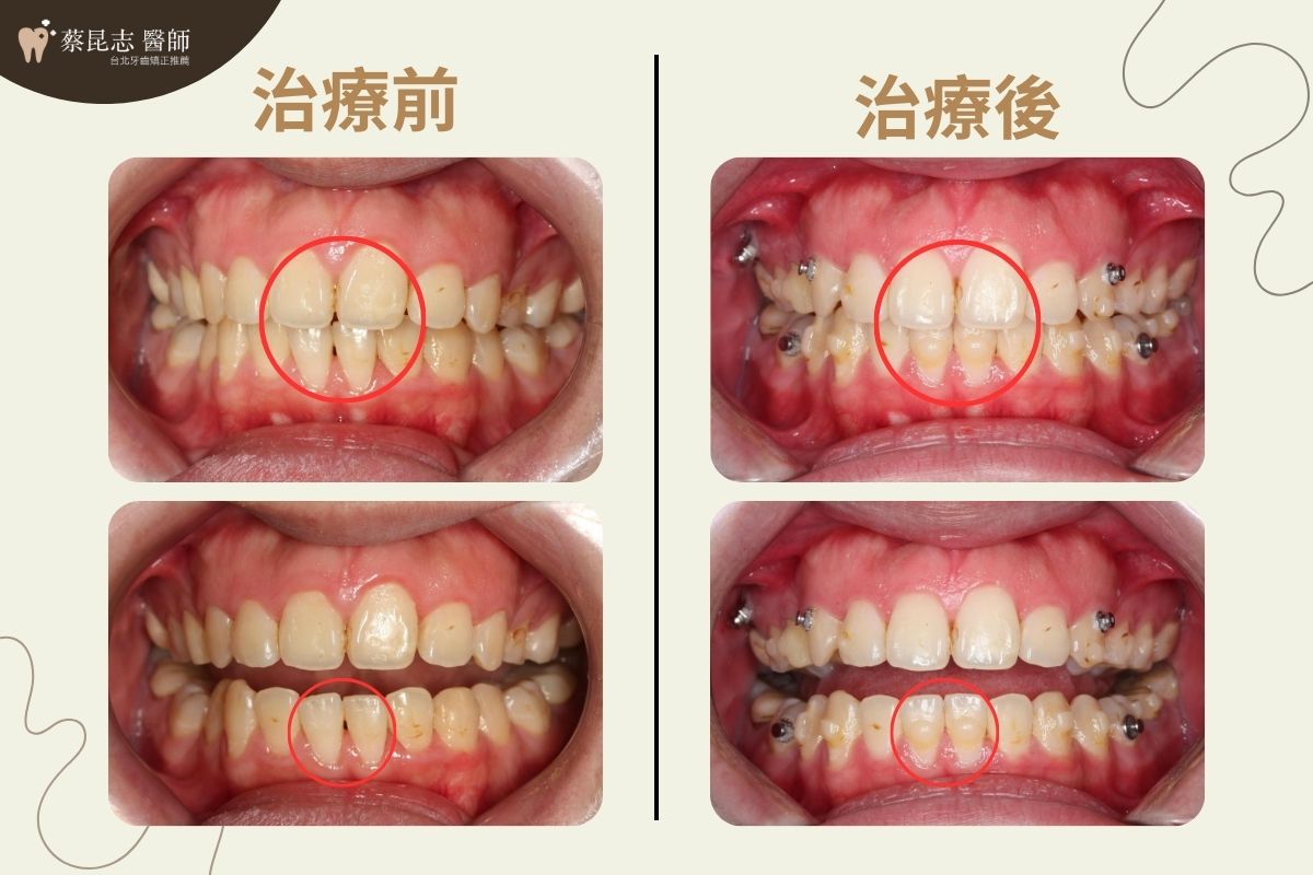 用隱適美做二次矯正，上下門牙水平差距縮小