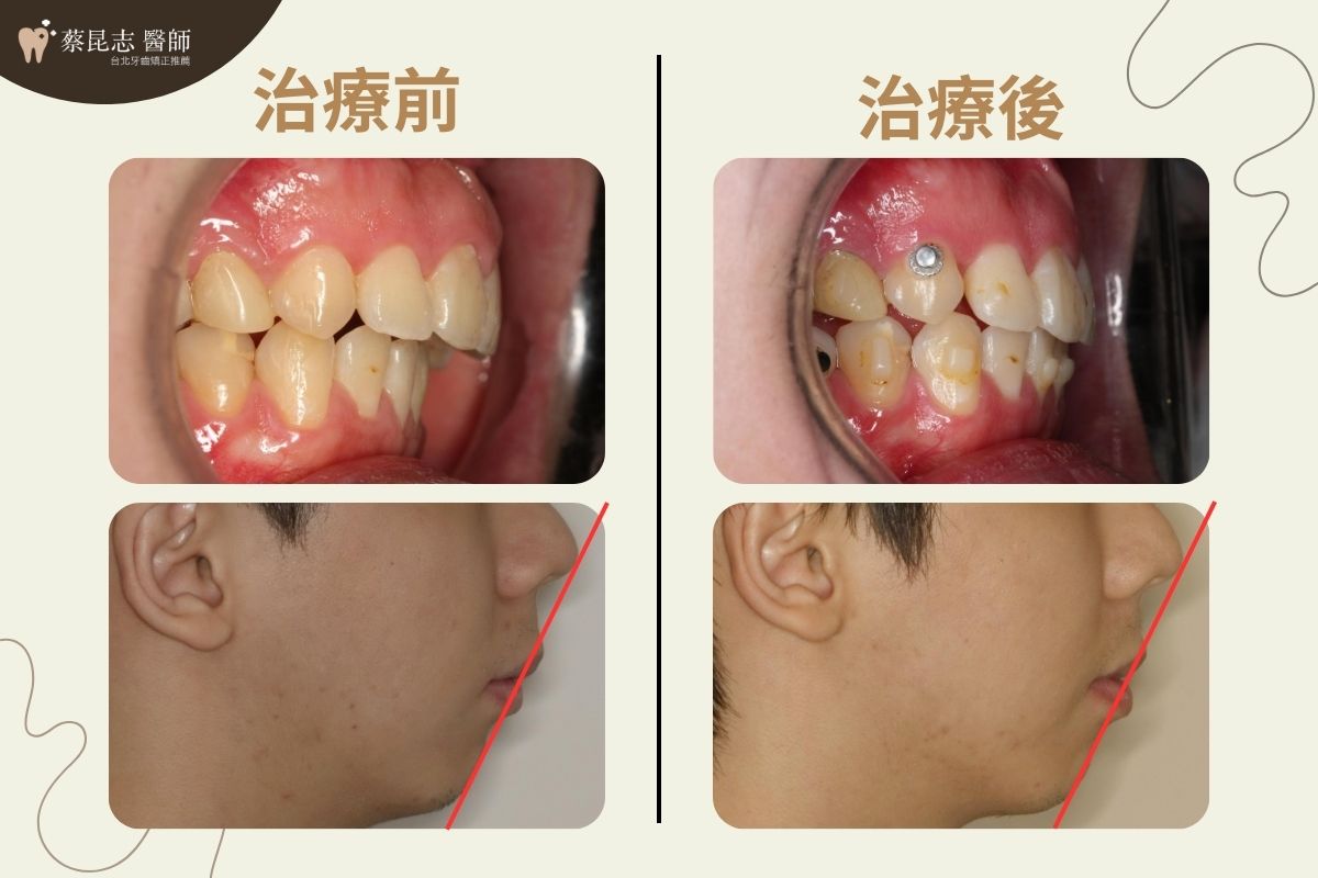 用隱適美做二次矯正，上下唇差距縮小