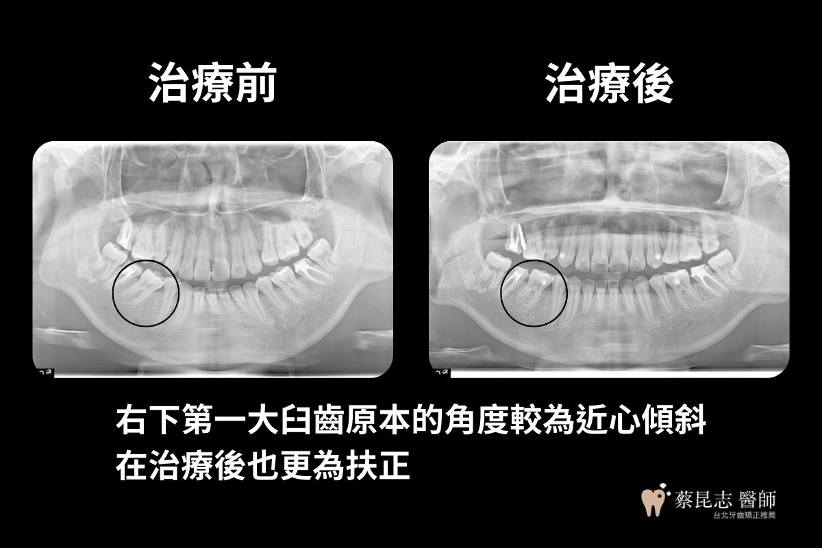 用隱適美做二次矯正，右下第一大臼齒扶正