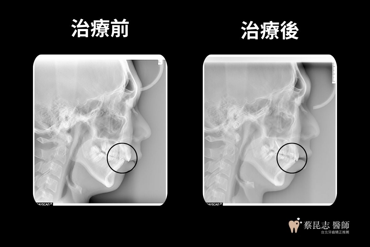 用隱適美做二次矯正，上下牙差距減小