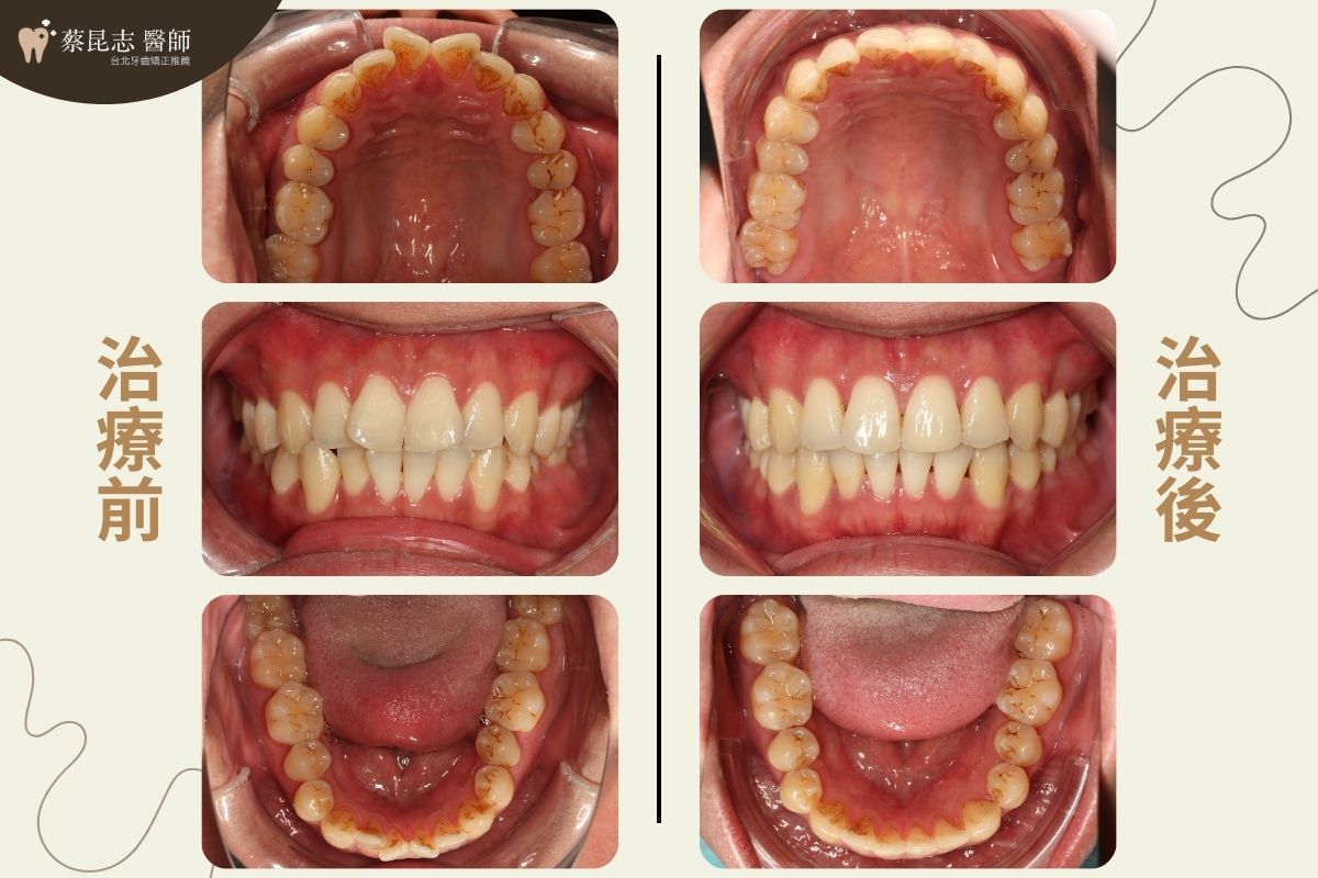 隱適美矯正嘴唇外凸前後口腔正面變化照