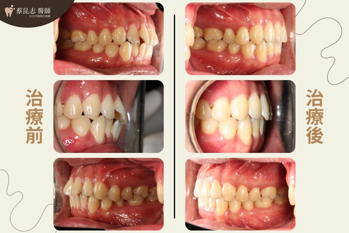 隱適美矯正嘴唇外凸前後口腔側面變化照