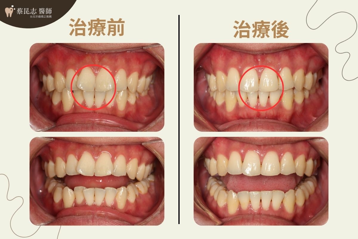 隱適美矯正嘴唇外凸前後門牙變化照