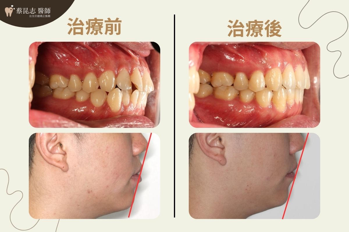 隱適美矯正嘴唇外凸前後嘴型變化照