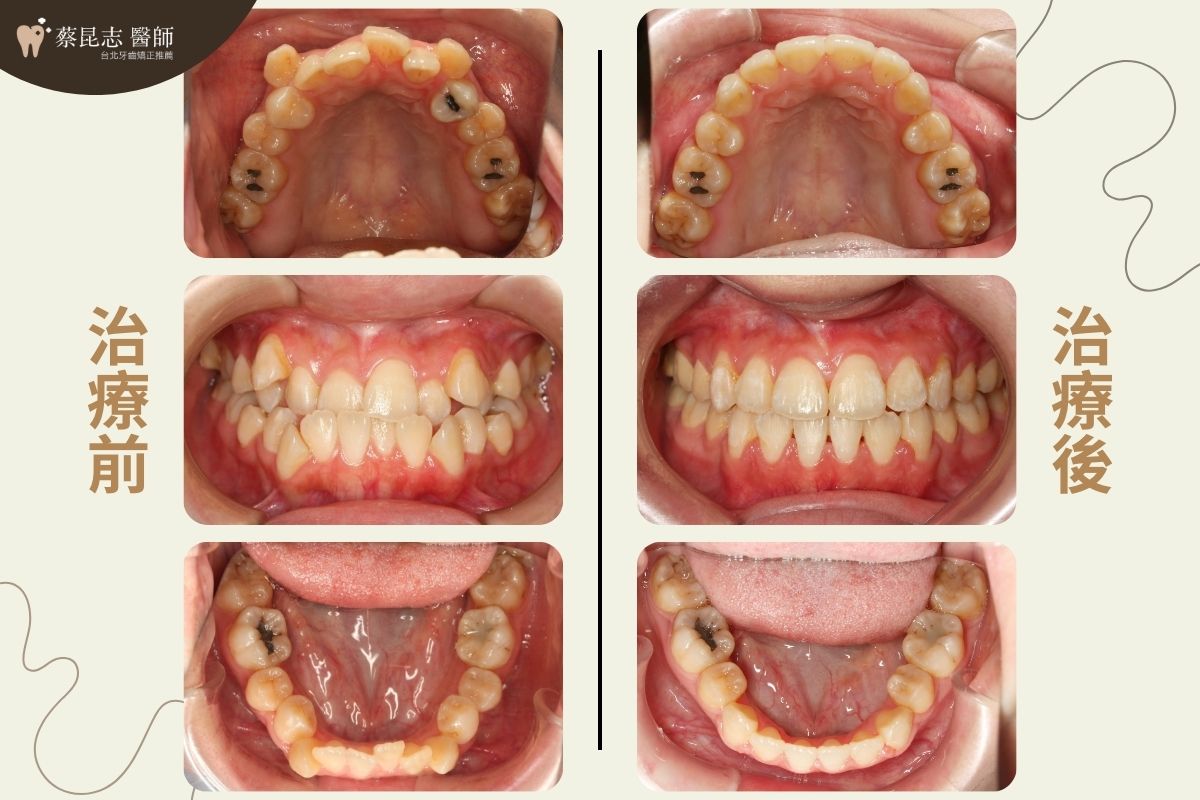 前牙錯咬戽斗矯正前後口腔變化