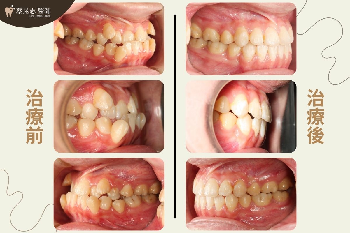 前牙錯咬戽斗矯正前後口腔側面變化