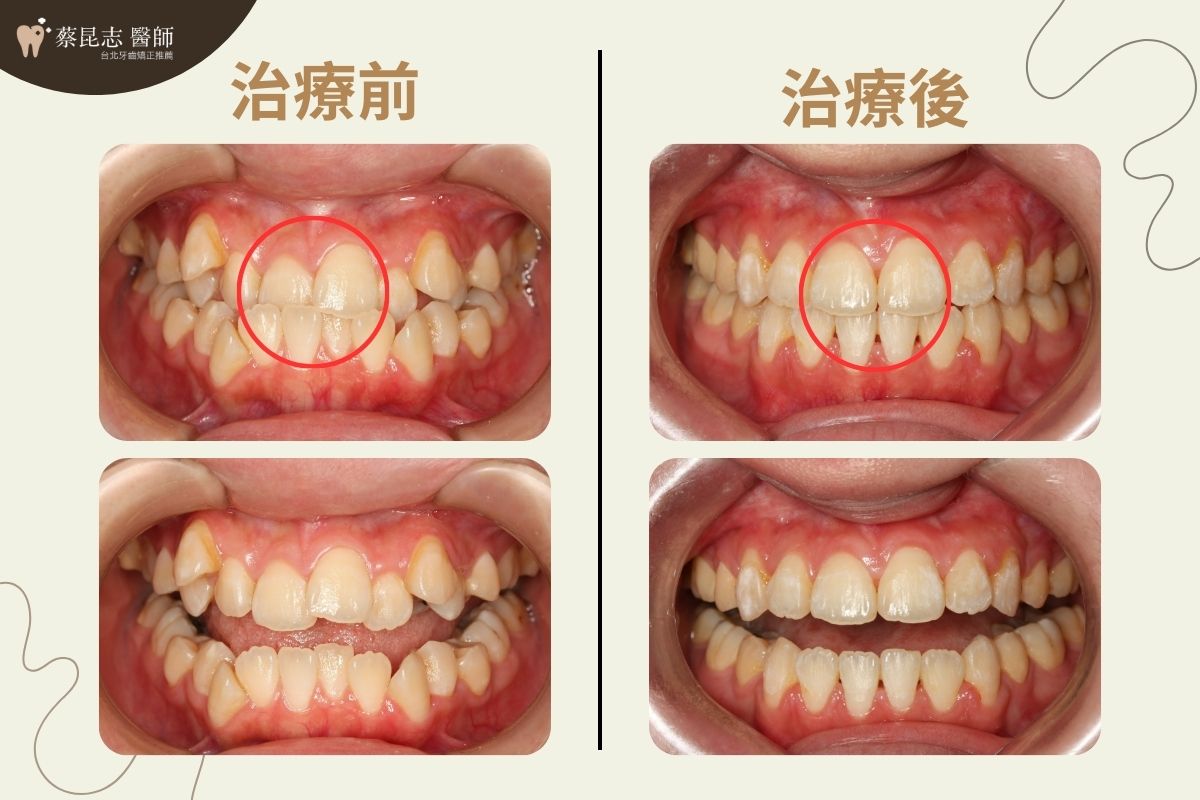 前牙錯咬戽斗矯正前後門牙變化