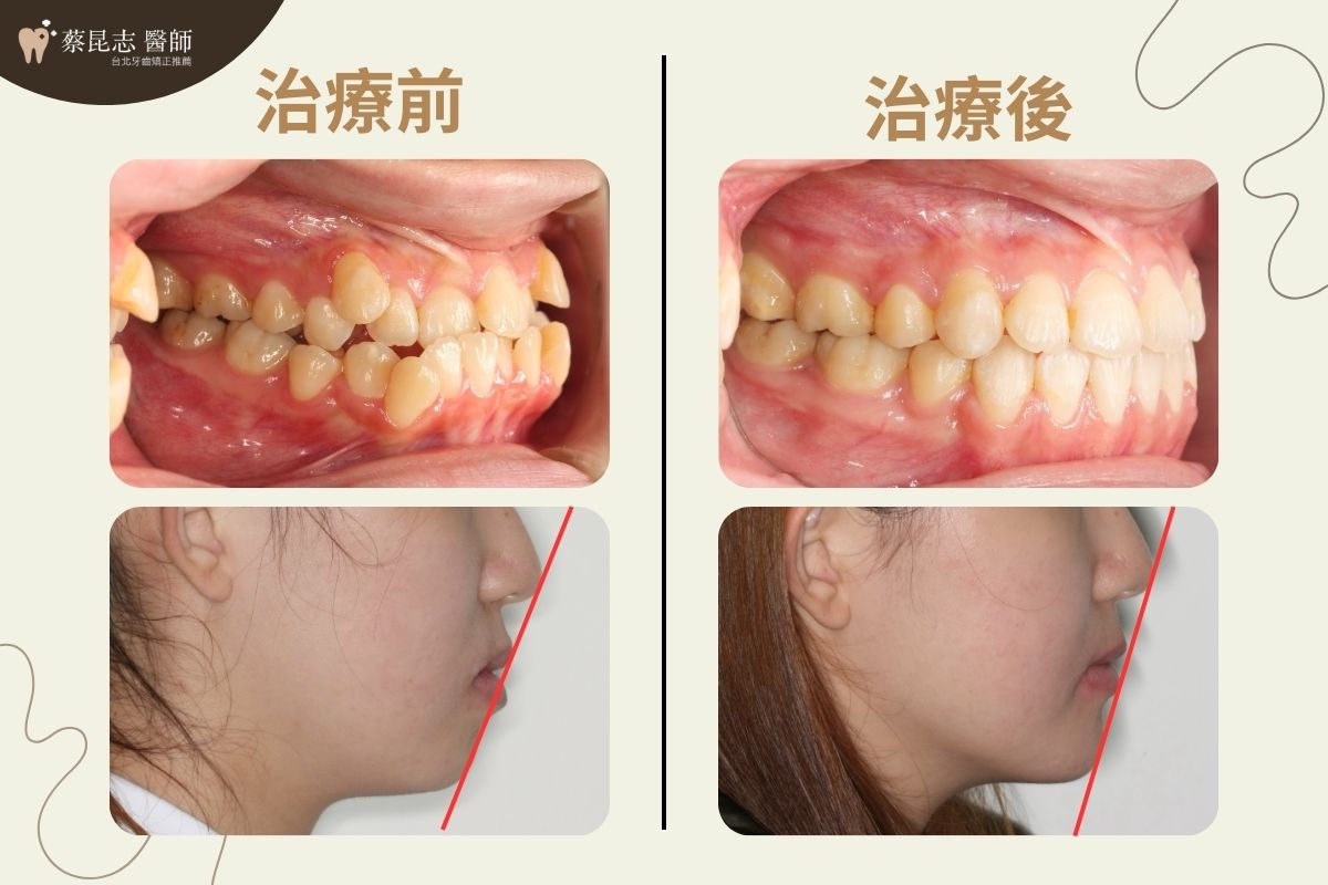 前牙錯咬戽斗矯正前後嘴型變化