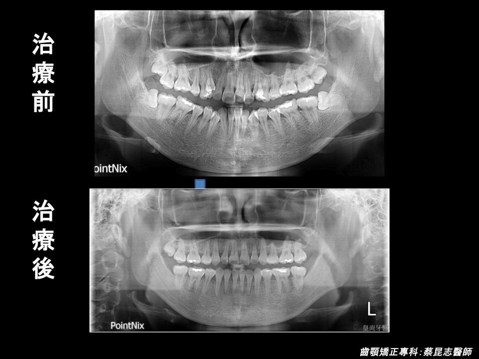 前牙錯咬戽斗矯正前後正面x光變化