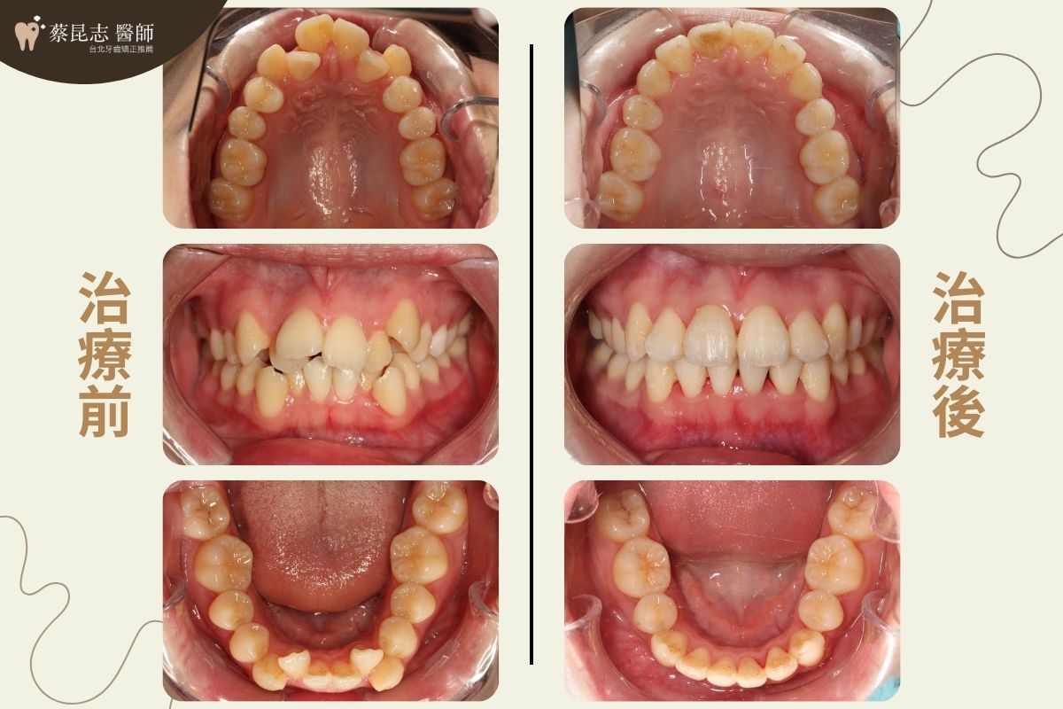 暴牙拔牙矯正前後口腔正面照對比