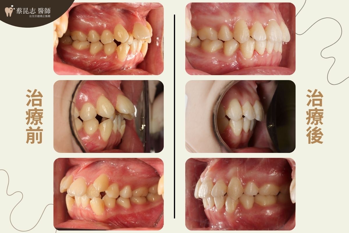 暴牙拔牙矯正前後口腔側面照對比