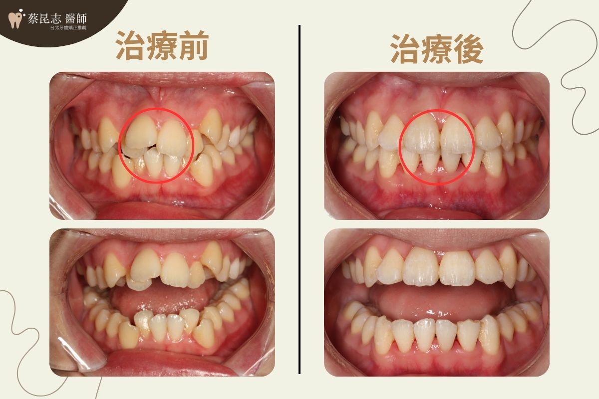 暴牙拔牙矯正前後門牙變化對比