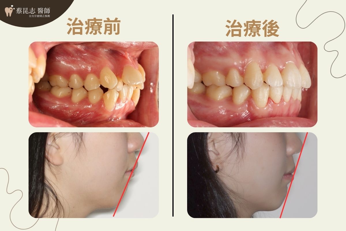 暴牙拔牙矯正前後嘴型變化