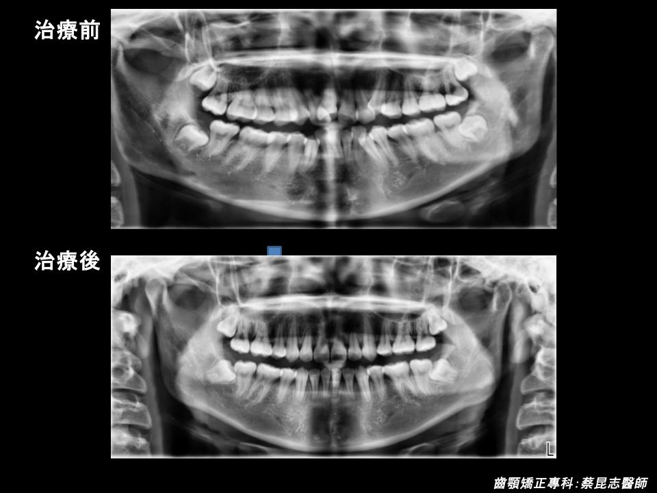 暴牙拔牙矯正前後x光變化